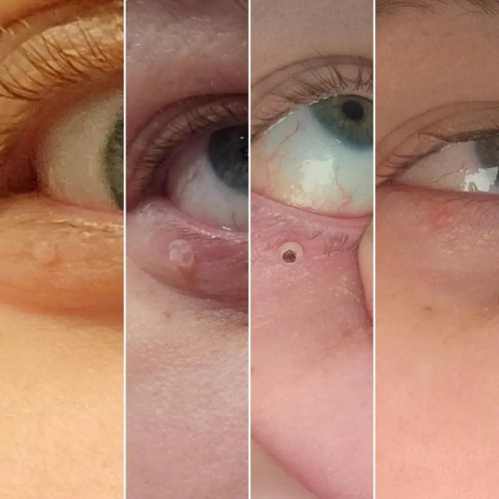 ClearTouch® | Kit completo per rimuovere fibromi cutanei senza dolore