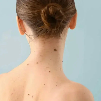 ClearTouch® | Kit completo per rimuovere fibromi cutanei senza dolore