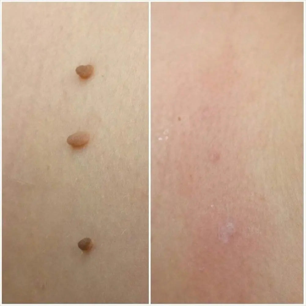 ClearTouch® | Kit completo per rimuovere fibromi cutanei senza dolore